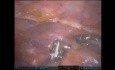 Robot-assisted Minimal Invasive CABG Using Bilateral Thoracic Arteries