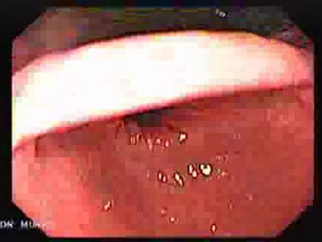 High Resolution Video Endoscopy with Zoom - Antrum and Incisura Angularis