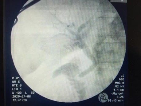 IOC: Intraoperative Cholangiography