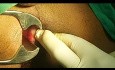 Closed Lateral Internal Sphincterotomy