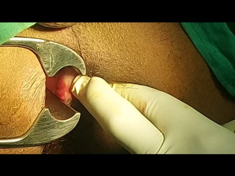 Closed Lateral Internal Sphincterotomy
