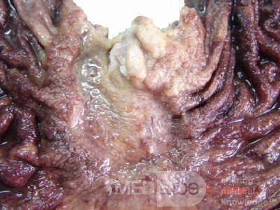 Adenocarcinoma of the cardias and gastric fundus with signet-ring cells (15 of 25)