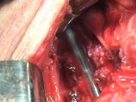 Perforation of a Esophageal Carcinoma After the Procedure with Hydrostatic Balloon Dilation -  Presentation of the Lesion