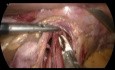 Laparoscopic Heller Cardiomyotomy