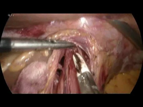 Laparoscopic Heller Cardiomyotomy