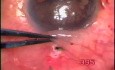 Juvenile glaucoma with aniridia and microcornea - surgery with use Fugo Blade