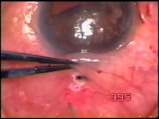Juvenile glaucoma with aniridia and microcornea - surgery with use Fugo Blade