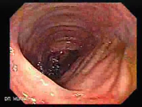 Colonoscopy with Dilation (7 of 8)