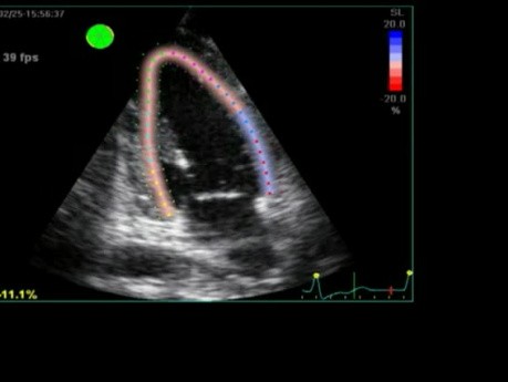 Overloading Of The Heart In Echocardiography