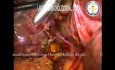 Laparoscopic Choledochal Cyst Excision