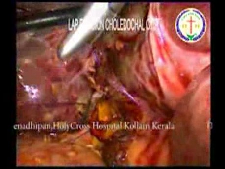 Laparoscopic Choledochal Cyst Excision