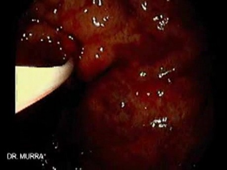 Gastric Varices (11 of 25)
