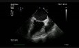 Mitral Valve Infective Endocarditis