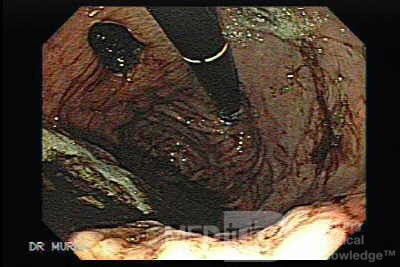 Gastric Cancer - A Large Ulcer at the the Posterior Wall of the Gastric Fundus