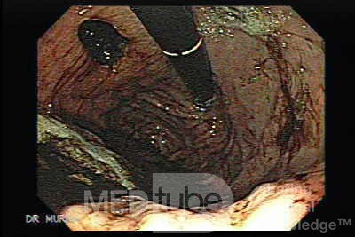 Gastric Cancer - A Large Ulcer at the the Posterior Wall of the Gastric Fundus
