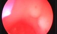 Neurosurgery endotrainer- video