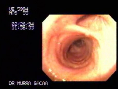 Endoscopic Assessment of Tracheal Bifurcation