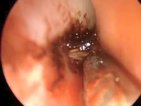 Endoscopic Ligation of Left Anterior Ethmoidal Artery