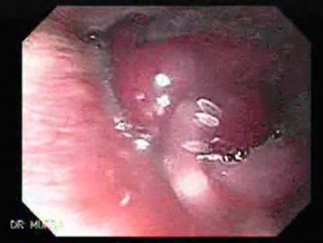 Hemangioma of the Larynx