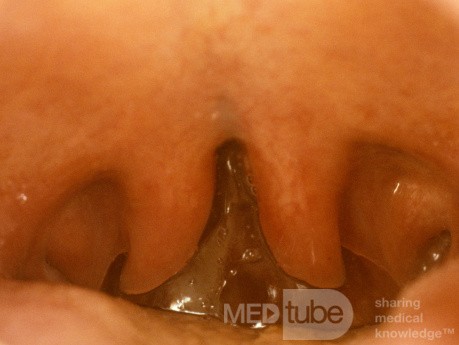 Bifid Uvula