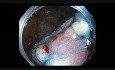 Colonoscopy Channel Quiz 21