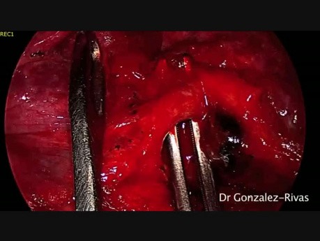 Non Intubated Uniportal Video-Assisted Thoracoscopic Left Upper Lobectomy