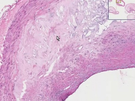 Atherosclerosis - Histopathology - Coronary arteries