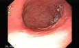 Endoscopy of gastric cancer