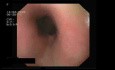 Stage I Of Esophageal Varices 