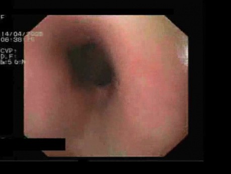 Stage I Of Esophageal Varices 