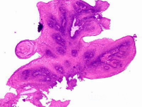 Endoscopy of Esophageal Papilloma (4 of 4)