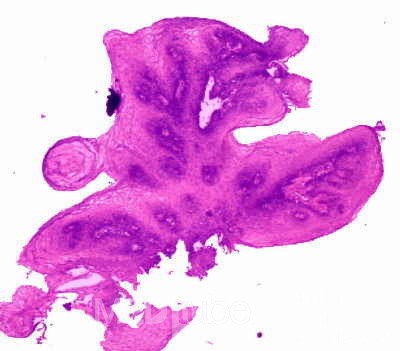 Endoscopy of Esophageal Papilloma (4 of 4)