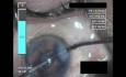 Cataract Surgery VI - Part 3