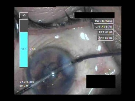 Cataract Surgery VI - Part 3