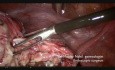 Endometriosis Ovarian Cystectomy for Residents (Live Surgery)