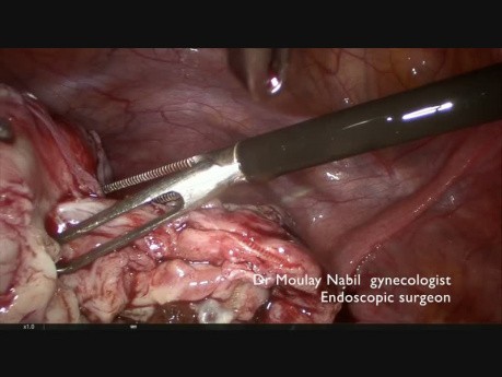Endometriosis Ovarian Cystectomy for Residents (Live Surgery)
