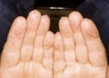 Osler Weber Rendu Disease Fingers