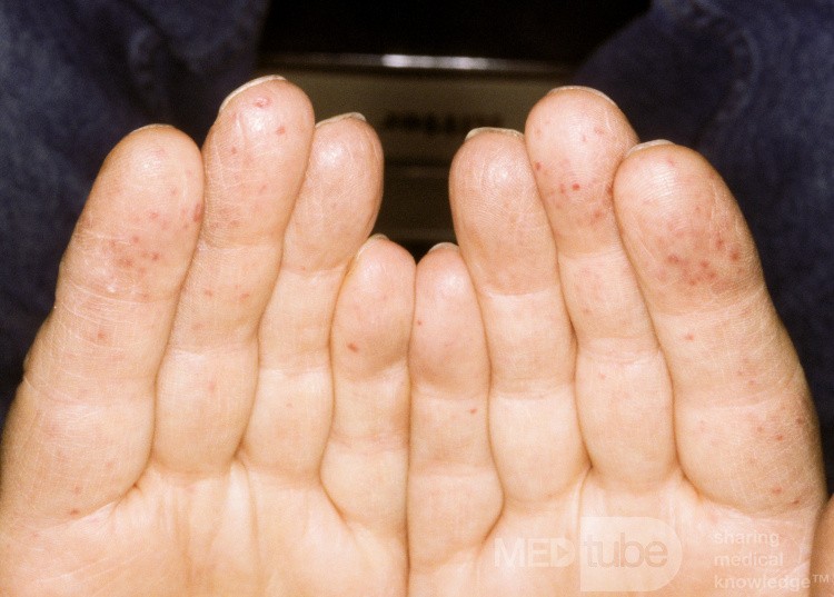 Osler Weber Rendu Disease Fingers