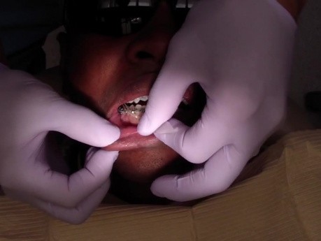 Orthodontic Case #3 - Mesialize Maxillary Posterior Segment W/ Class 3 Elastics