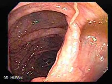 Non Familial Juvenile Polyposis Of The Colon (19 of 37)