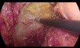 Laparoscopic TME with Monopolar Hook Electrocautery