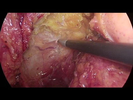 Laparoscopic TME with Monopolar Hook Electrocautery