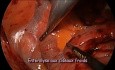 Reverse Hartmann Procedure by Single Port