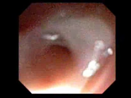 Endoscopy Through The Gastrostomy Fistula - Occluded Gastric Cardia