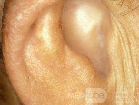 Atresia of the External Canal