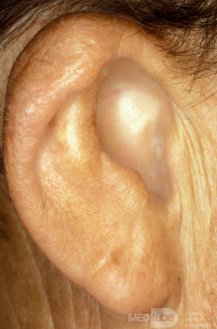 Atresia of the External Canal