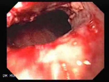 Synchronous Cancer (Gastric and Esophageal) - Visualization of the Malignancy of the Middle Third of Esophagus