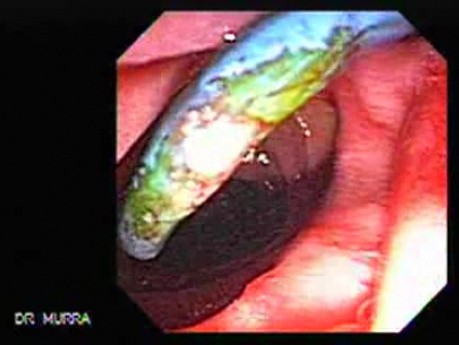 Adenocarcinoma of the Vater Papilla - Stent Migration (1 of 7)