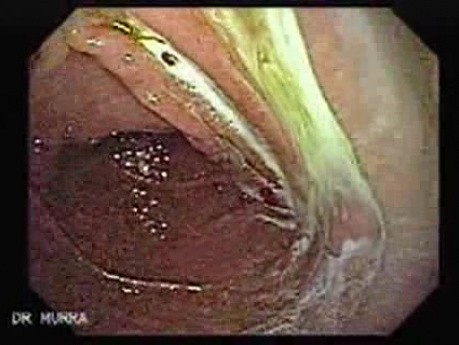 Duodenal Lymphangiectasia (4 of 5)