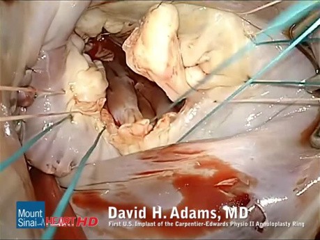 Mitral Valve Repair Featuring the First U.S. Implant of the Physio II Annuloplasty Ring